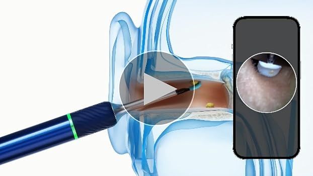 Bebird Note5 Blue Otoscope with camera_3